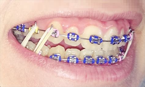 gomas de brackets